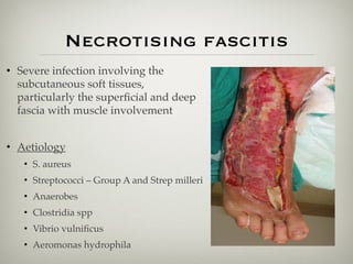 Necrotising fascitis
• Severe infection involving the
subcutaneous soft tissues,
particularly the superﬁcial and deep
fascia with muscle involvement
• Aetiology
• S. aureus
• Streptococci – Group A and Strep milleri
• Anaerobes
• Clostridia spp
• Vibrio vulniﬁcus
• Aeromonas hydrophila
 