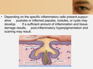 • Depending on the specific inflammatory cells present,suppur-
  ative    pustules or inflamed papules, nodules, or cysts may
  develop.     If a sufficient amount of inflammation and tissue
  damage results, post-inflammatory hyperpigmentation and
  scarring may result.
 