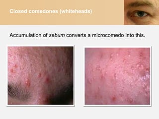 Closed comedones (whiteheads)



Accumulation of sebum converts a microcomedo into this.
 