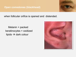 Open comedones (blackhead)


when follicular orifice is opened and distended.



     Melanin + packed
 keratinocytes + oxidized
  lipids  dark colour
 