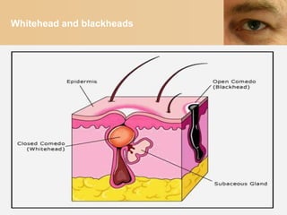 Whitehead and blackheads
 