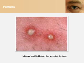 Pustules




           inflamed pus filled lesions that are red at the base.
 