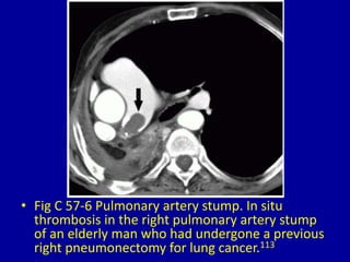 57 filling defect in pulmonary artery on computed | PPTX