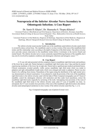 IOSR Journal of Dental and Medical Sciences (IOSR­JDMS)  
e­ISSN: 2279­0853, p­ISSN: 2279­0861.Volume 15, Issue 3 Ver. VII (Mar. 2016), PP 14­17  
www.iosrjournals.org  
 
Neuropraxia of the Inferior Alveolar Nerve Secondary to 
Odontogenic Infection: A Case Report 
 
Dr. Samir D. Khaire​1​
, Dr. Shameeka S. Thopte (Khaire)​2 
1 ​
(Assistant Professor (Maxillofacial and Oral Surgeon), Department of Dentistry, Byramjee Jeejeebhoy 
Government Medical College & Sassoon General Hospitals’ Pune, Maharashtra University of Health Sciences, 
Nasik, India) 
2 ​
(Assistant Professor in Oral Medicine, Diagnosis & Radiology, Department of Oral Medicine, Diagnosis & 
Radiology, Bharati Vidyapeeth Deemed University Dental College & Hospital, Pune, India) 
 
I. Introduction 
The inferior alveolar neurovascular bundle runs in the mandibular canal (inferior alveolar canal) which                           
is covered by dense cortical bone. The mandibular canal is in close vicinity of the roots of the mandibular third                                       
molars and this relationship varies according to the depth of impaction of the third molars. The inferior alveolar                                   
nerve provides sensory innervation to the mandibular molars before it terminates in the incisive branch and                               
mental branch. The inferior alveolar nerve is more commonly injured following fractures of the mandible, but it                                 
may also be involved by neoplastic conditions and odontogenic infections and iatrogenic causes ​1,2,3,4​
. 
 
II. Case Report 
A 32 year old male presented with the complaint of pain in mandibular right third molar and numbness                                   
of the lower lip on right side. Patient had pain in mandibular right third molar since 2 days and then he started                                           
experiencing numbness of the lower lip on right side. Patient had no significant past medical and dental history.                                   
Clinical examination revealed partially visible carious mandibular right third molar which was tender to                           
palpation and right submandibular lymph nodes which were enlarged and tender to palpation. Patient was also                               
found to be suffering from trismus. Paraesthesia of the region along the distribution of the right mental nerve                                   
was demonstrated on clinical examination. It was planned to study the proximity of the roots of the mandibular                                   
right third molar to the inferior alveolar canal with the help of Plain Computed tomography scan (CT Scan) of                                     
mandible; control the odontogenic infection with medication and then under local anaesthesia, extract the                           
mandibular right third molar surgically by sectioning of the tooth. Anticipating close proximity of the roots of                                 
the mandibular right third molar to the inferior alveolar canal, plain CT scan of mandible was done. As                                   
anticipated, the CT scan revealed close proximity of the roots of the mandibular right third molar to the inferior                                     
alveolar canal and periapical rarefaction in close vicinity of the inferior alveolar canal (See Fig. 1, 2, 3).  
 
Fig.1 Computed tomography scan of patient (Coronal view) 
 
 
 
 
 
 
 
 
 
 
 
 
 
 
 
 
DOI: 10.9790/0853­1503071417                         www.iosrjournals.org                                                   14 | Page 
 