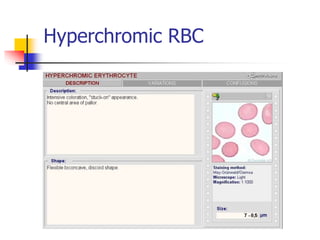Hyperchromic Definition Classifications of anemias 5830599.ppt