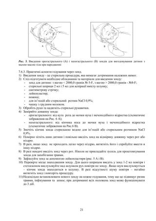 Рис. 5. Введення орогастрального (А) і назогастрального (В) зондів для вигодовування дитини з
малою масою тіла при народженні

7.6.3. Практичні аспекти годування через зонд.
1) Введення зонду - це стерильна процедура, яка вимагає дотримання належних вимог.
2) Слід підготувати необхідне обладнання та матеріали для введення зонду:
     - зонд для дитини: з вагою < 2000,0 грамів № 5-F, з вагою > 2000,0 грамів - №8-F;
     - стерильні шприци 2 мл і 5 мл для аспірації вмісту шлунку;
     - сантиметрову стрічку;
     - лейкопластир;
     - ножиці;
     - для ін’єкцій або стерильний розчин NaCl 0,9%;
     - чашку з грудним молоком.
3) Обробіть руки та надягніть стерильні рукавички.
4) Заміряйте довжину зонда:
     - орогастрального: від кута рота до мочки вуха і мечоподібного відростка (схематичне
        зображення на Рис. 6 А);
     - назогастрального: від кінчика носа до мочки вуха і мечоподібного відростка
        (схематичне зображення на Рис.6 В).
5) Змочіть кінчик зонда стерильною водою для ін’єкцій або стерильним розчином NaCl
    0,9%.
6) Помірно зігніть шию дитини і повільно введіть зонд на відміряну довжину через рот або
    ніздрю.
7) В разі, якщо зонд не проходить легко через ніздрю, витягніть його і спробуйте ввести в
    іншу ніздрю.
8) В разі невдачі введіть зонд через рот. Ніколи не прикладайте зусиль для проштовхування
    зонда для запобігання травми.
9) Зафіксуйте зонд за допомогою лейкопластиря (рис. 5 А і В).
10) Перевірте місце знаходження зонду. Для цього шприцом введіть у зонд 1-2 мл повітря і
    стетоскопом вислуховуйте над шлунком рух повітря по зонду. Якщо шум вислуховується
    – кінчик зонда знаходиться в шлунку. В разі відсутності шуму повітря – негайно
    витягніть зонд і повторіть процедуру.
11) Недоцільно встановлювати нового зонду на кожне годування, тому що це підвищує ризик
    травми, інфікування та апное; при дотриманні всіх положень зонд може функціонувати
    до 3 діб.




                                             21
 