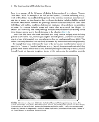 The Bioarchaeology Of Metabolic Bone Disease 2nd Edition Megan Brickley ...