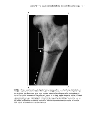 The Bioarchaeology Of Metabolic Bone Disease 2nd Edition Megan Brickley ...