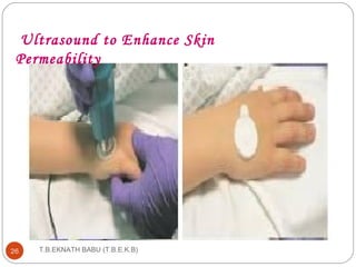 Ultrasound to Enhance Skin 
Permeability 
T.B.EKNATH 26 BABU (T.B.E.K.B) 
 
