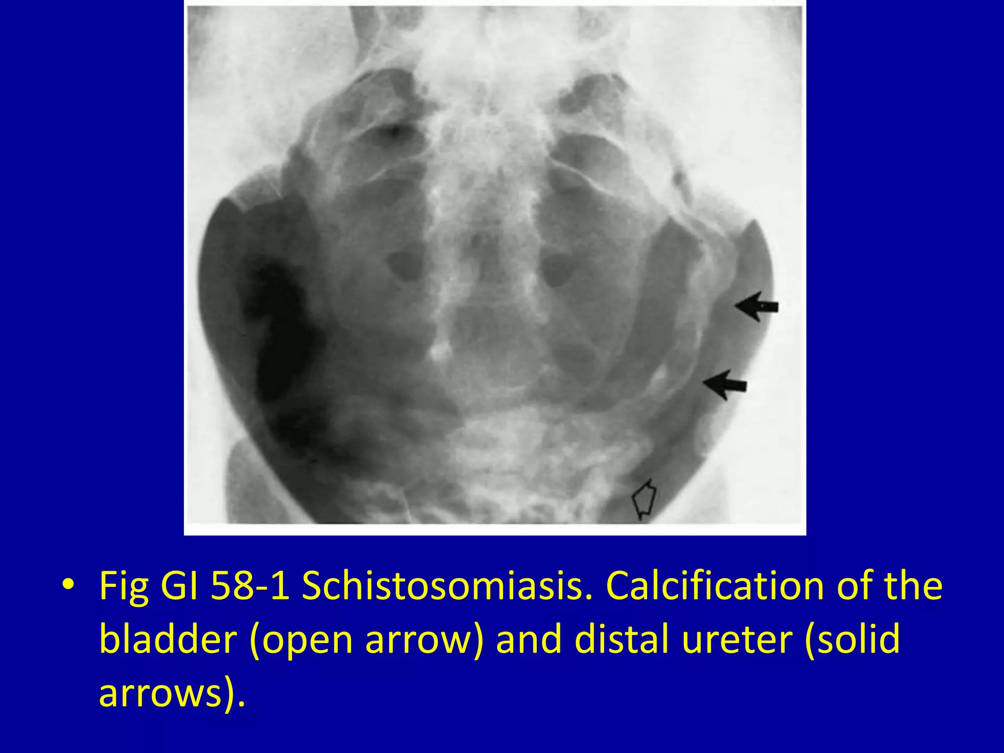 • Fig GI 58-1 Schistosomiasis. Calcification of the
bladder (open arrow) and distal ureter (solid
arrows).