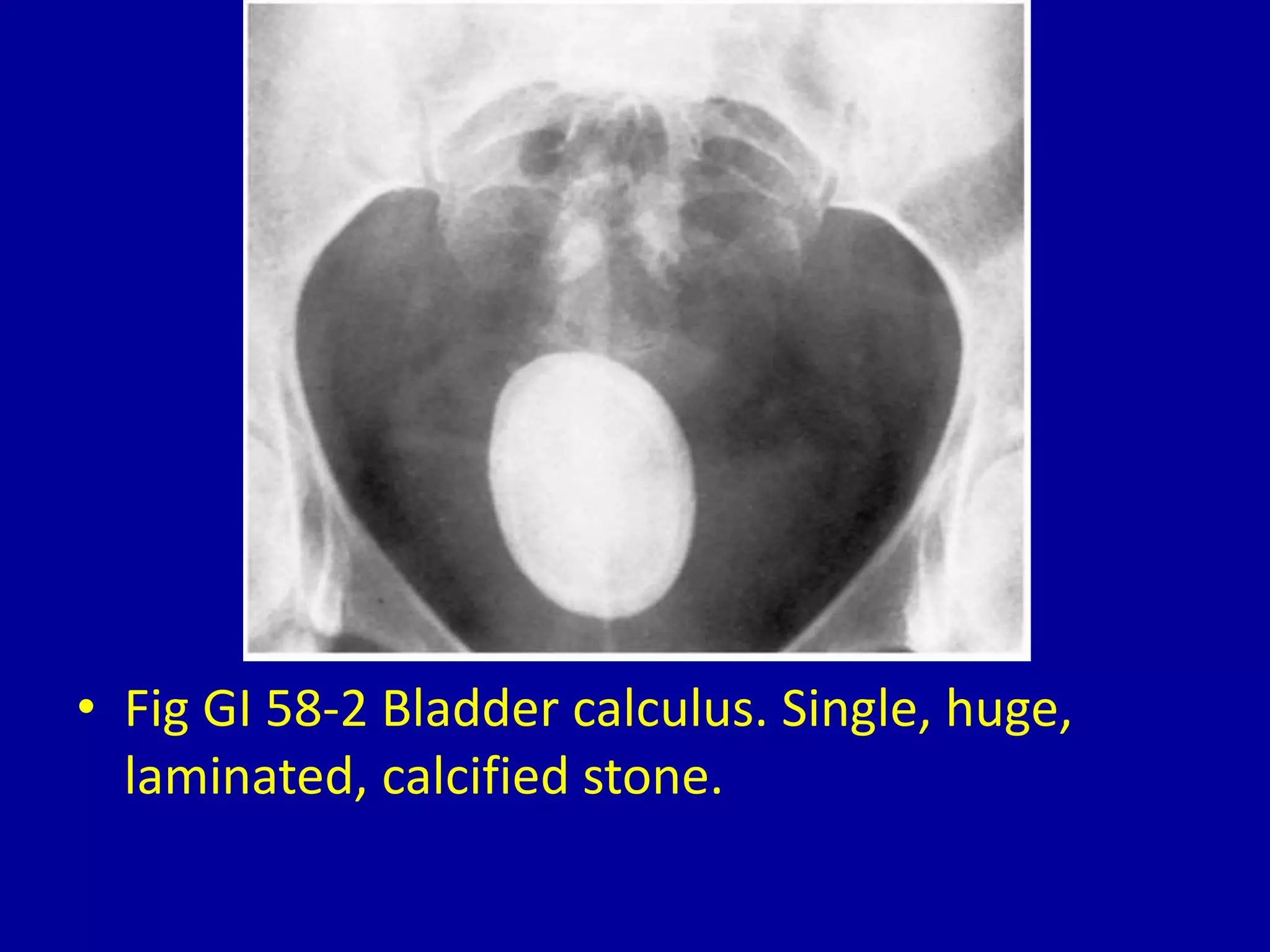 • Fig GI 58-2 Bladder calculus. Single, huge,
laminated, calcified stone.