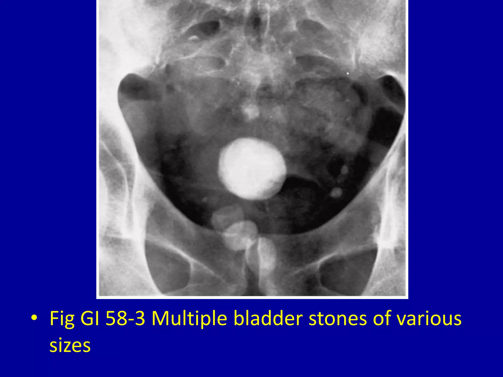 • Fig GI 58-3 Multiple bladder stones of various
sizes