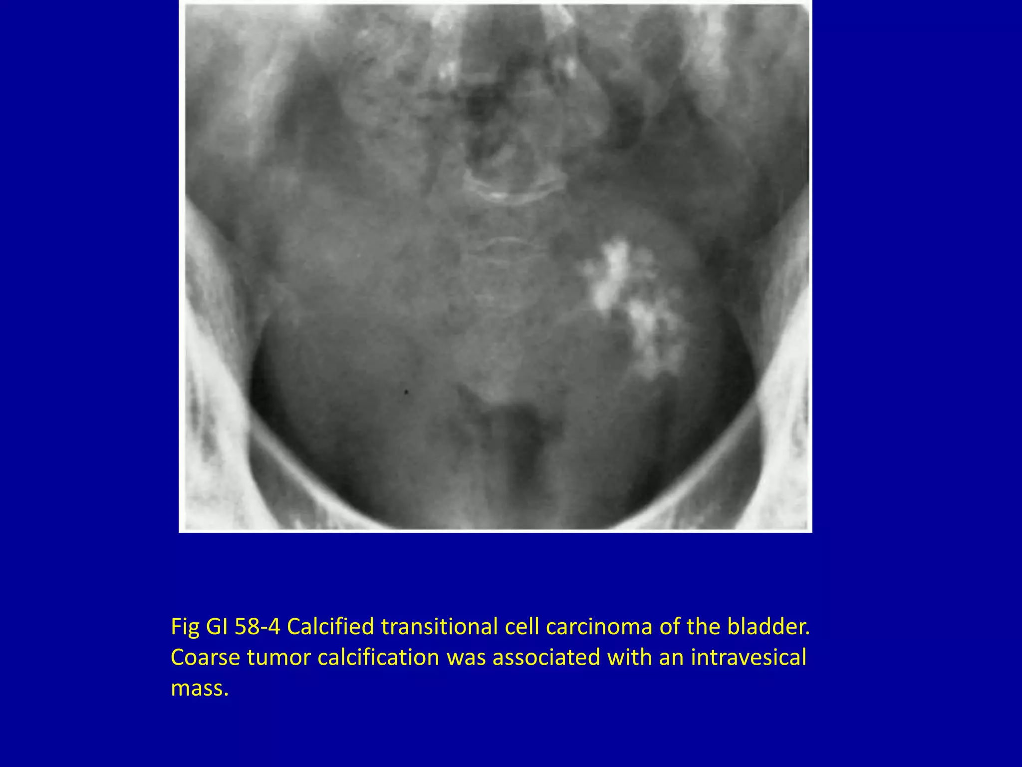 Fig GI 58-4 Calcified transitional cell carcinoma of the bladder.
Coarse tumor calcification was associated with an intravesical
mass.