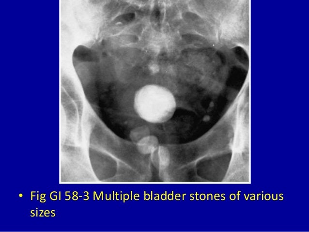 58 bladder calcification