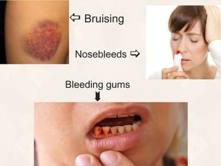 Nosebleeds 
 Bruising
Bleeding gums

 