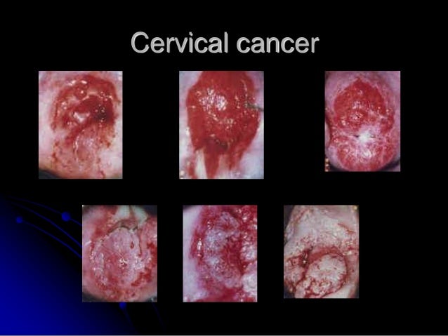 59592899 kangker-serviks