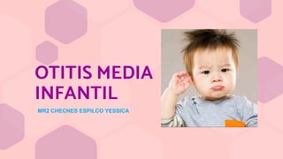OTITIS MEDIA
INFANTIL
MR2 CHECNES ESPILCO YESSICA
 