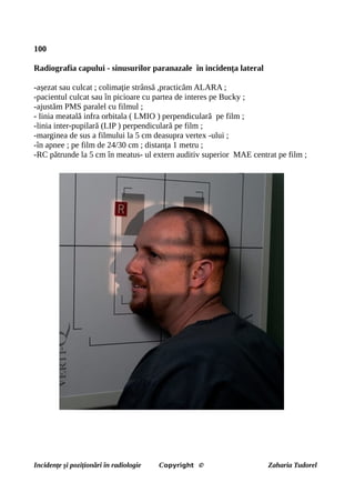 100
Radiografia capului - sinusurilor paranazale în incidența lateral
-așezat sau culcat ; colimație strânsă ,practicăm ALARA ;
-pacientul culcat sau în picioare cu partea de interes pe Bucky ;
-ajustăm PMS paralel cu filmul ;
- linia meatală infra orbitala ( LMIO ) perpendiculară pe film ;
-linia inter-pupilară (LIP ) perpendiculară pe film ;
-marginea de sus a filmului la 5 cm deasupra vertex -ului ;
-în apnee ; pe film de 24/30 cm ; distanța 1 metru ;
-RC pătrunde la 5 cm în meatus- ul extern auditiv superior MAE centrat pe film ;
Incidențe și poziționări în radiologie Copyright © Zaharia Tudorel
 
