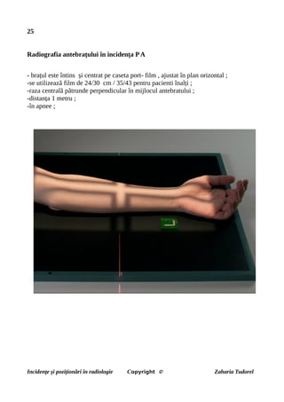 25
Radiografia antebrațului în incidența PA
- brațul este întins și centrat pe caseta port- film , ajustat în plan orizontal ;
-se utilizează film de 24/30 cm / 35/43 pentru pacienti înalți ;
-raza centrală pătrunde perpendicular în mijlocul antebratului ;
-distanța 1 metru ;
-în apnee ;
Incidențe și poziționări în radiologie Copyright © Zaharia Tudorel
 