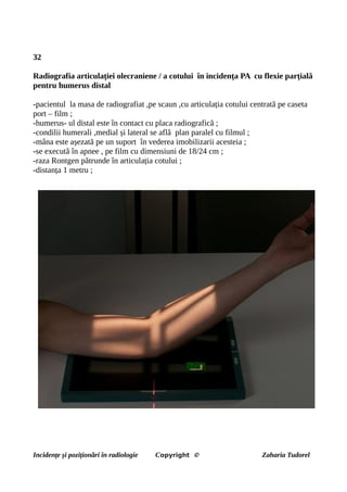 32
Radiografia articulației olecraniene / a cotului în incidența PA cu flexie parțială
pentru humerus distal
-pacientul la masa de radiografiat ,pe scaun ,cu articulația cotului centrată pe caseta
port – film ;
-humerus- ul distal este în contact cu placa radiografică ;
-condilii humerali ,medial și lateral se află plan paralel cu filmul ;
-mâna este așezată pe un suport în vederea imobilizarii acesteia ;
-se execută în apnee , pe film cu dimensiuni de 18/24 cm ;
-raza Rontgen pătrunde în articulația cotului ;
-distanța 1 metru ;
Incidențe și poziționări în radiologie Copyright © Zaharia Tudorel
 