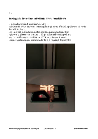 52
Radiografia de calcaneu în incidența lateral / mediolateral
- piciorul pe masa de radiografiat extins ;
-din poziția așezat pacientul se rostogolește pe partea afectată a piciorului cu partea
laterală pe film ;
-se ajustează piciorul cu suprafața plantara perpendicular pe film ;
-piciorul și glezna sunt ajustate la 90 gr. calcaneul centrat pe film ;
-se execută în apnee ; pe filme de 18/24 cm ; distanța 1 metru ;
-raza centrală pătrunde perpendicular la 3- 4 cm distal de maleole ;
Incidențe și poziționări în radiologie Copyright © Zaharia Tudorel
 