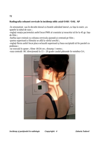 72
Radiografia coloanei cervicale în incidența oblic axial OAR / OAL AP
-în ortostatism sau în decubit dorsal cu bratele atârnând lateral ,cu fața la stativ ,cu
spatele la tubul de raze ;
-reglați rotația pacientului astfel încat PMS al craniului și toracelui să fie la 45 gr. fața
de film ;
-barbia ușor extinsă cu coloana cervicala ajustată și centrată pe film ;
-partea superioară a filmului se află la vârful urechii ;
-reglați flexia astfel încat placa ocluzală superioară și baza occipitală să fie paralel cu
podeaua ;
-se execută în apnee ; filme 18/24 cm ; distanța 1 metru ;
-raza centrală RC direcționată la 15 – 20 grade caudal pătrunde în vertebra C4 ;
Incidențe și poziționări în radiologie Copyright © Zaharia Tudorel
 