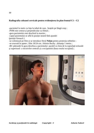 77
Radiografia coloanei cervicale pentru evidențierea în plan frontal C1 – C2
-pacientul la stativ cu fața la tubul de raze, brațele pe lângă corp ;
-PSM este centrat și perpendicular cu filmul ;
-gura pacientului este deschisă la maxim ;
-capul pacientului se află în poziție neutră fără ajustări
(poziție firească )
-se colimează pe film și se introduce fitrul Nolan pentru protecția orbitelor ;
-se execută în apnee ; film 18/24 cm ; folosin Bucky ; distanța 1 metru ;
-RC pătrunde în gura deschisa a pacientului paralel cu linia de la suprafață ocluzală
și superioară a incisivilor centrali și a occiputului (baza osului occipital) ;
Incidențe și poziționări în radiologie Copyright © Zaharia Tudorel
 