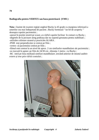 79
Radiografia pentru VERTEX sau baza posterioară (VMS )
Nota : înainte de examen reglați unghiul Bucky la 45 grade cu marginea inferioară a
umerilor cea mai îndepartată de pacient ; Bucky formează ‘’un fel de acoperiș ‘’
deasupra capului pacientului ;
-așezat în poziție neutră pe scaun ,cu vârful capului înclinat în contact cu Bucky ;
-degetele de la picioare ating podeaua dar nu suportă greutatea pentru stabilitate ;
-utilizăm colimare stransă și practicăm ALARA .
-PSM este perpendicular și centrat pe film ;
-vertex- ul pacientului centrat pe film ;
-filmul este centrat la un nivel de aprox. 2 cm simfizelor mandibulare ale pacientului ;
-se execută în apnee; pe film de 24/30 cm ; distanța 1 metru ; cu Bucky ;
-RC intră pe linia mediană simfizei mandibulare ,trecând anterior de meatul auditiv
extern și iese prin vârful craniului ;
Incidențe și poziționări în radiologie Copyright © Zaharia Tudorel
 