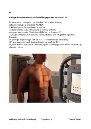 81
Radiografia coloanei toracale în incidența postero anterioară PA
-în ortostatism , sau așezat , pacientul cu fața la tubul de raze ;
-folosim colimație și practicăm ALARA ;
-PSM este perpendicular și centrat pe film ;
-coloana toracală (CT) este ajustată și centrată pe film ;
-marginea superioară a filmului se află la 3-4 cm deasupra C7 ;
- utilizăm filtru NOLAN din zona vârfului bărbiei spre RC pentru egalizarea
densitații ;
-în apnee pe inspiraîie ; pe film de 35/43 ; cu colimare de apropiere ;
-RC este perpendiculară și pătrunde anterior nivelului T6 ;
-la jumătatea distanței dintre crestatura jugulară dubla și procesul xifoid (manubrial) ;
-distanța 1 metru ;
Incidențe și poziționări în radiologie Copyright © Zaharia Tudorel
 