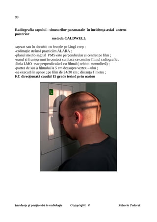 99
Radiografia capului - sinusurilor paranazale în incidența axial antero-
posterior
metoda CALDWELL
-așezat sau în decubit cu brațele pe lângă corp ;
-colimație strânsă practicăm ALARA ;
-planul medio sagital PMS este perpendicular și centrat pe film ;
-nasul și fruntea sunt în contact cu placa ce contine filmul radiografic ;
-linia LMO este perpendiculară cu filmul ( orbito- mentolieră) ;
-partea de sus a filmului la 5 cm deasupra vertex – ului ;
-se execută în apnee ; pe film de 24/30 cm ; distanța 1 metru ;
RC direcționată caudal 15 grade iesind prin nasion
Incidențe și poziționări în radiologie Copyright © Zaharia Tudorel
 