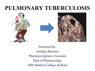 PULMONARY TUBERCULOSIS
Presented By:
Anindya Banerjee
Pharmacovigilance Associate
Dept of Pharmacology
NRS Medical College, Kolkata
 