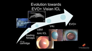 Evolution towards
EVO+ Visian ICL
V3 no
cartridge
loading
forceps
UBM
toric ICL
V4c
EVO+
 