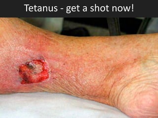 Tetanus	
  -­‐	
  get	
  a	
  shot	
  now!
 
