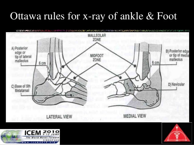 Ottawa Clinical Decision Rule A Prospective Validation Study For