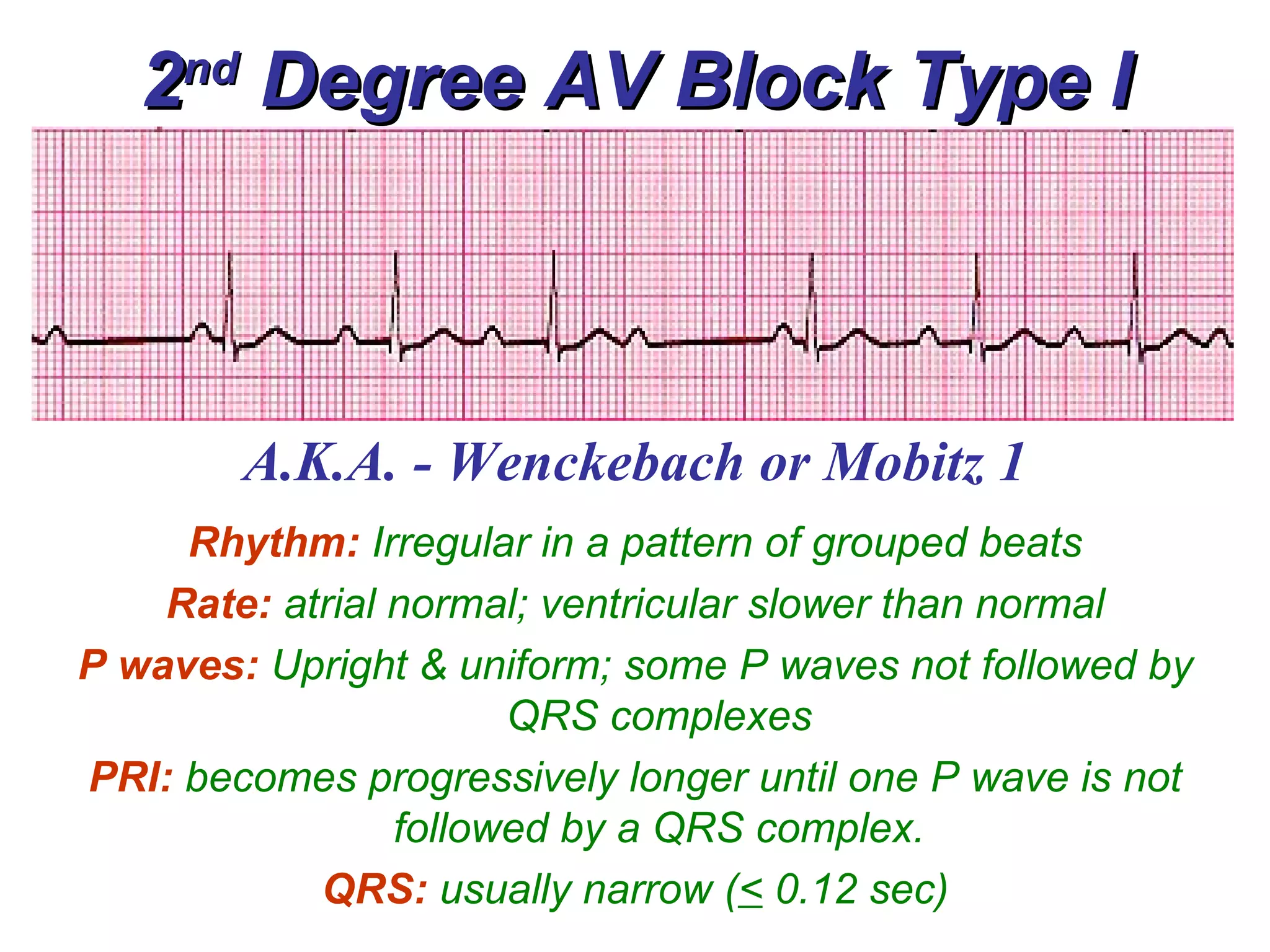 2 nd  Degree AV Block Type I A.K.A. - Wenckebach or Mobitz 1 Rhythm:   Irregular in a pattern of grouped beats Rate:   atrial normal; ventricular slower than normal P waves:   Upright & uniform; some P waves not followed by QRS complexes PRI:   becomes progressively longer until one P wave is not followed by a QRS complex. QRS:   usually narrow ( <  0.12 sec) 