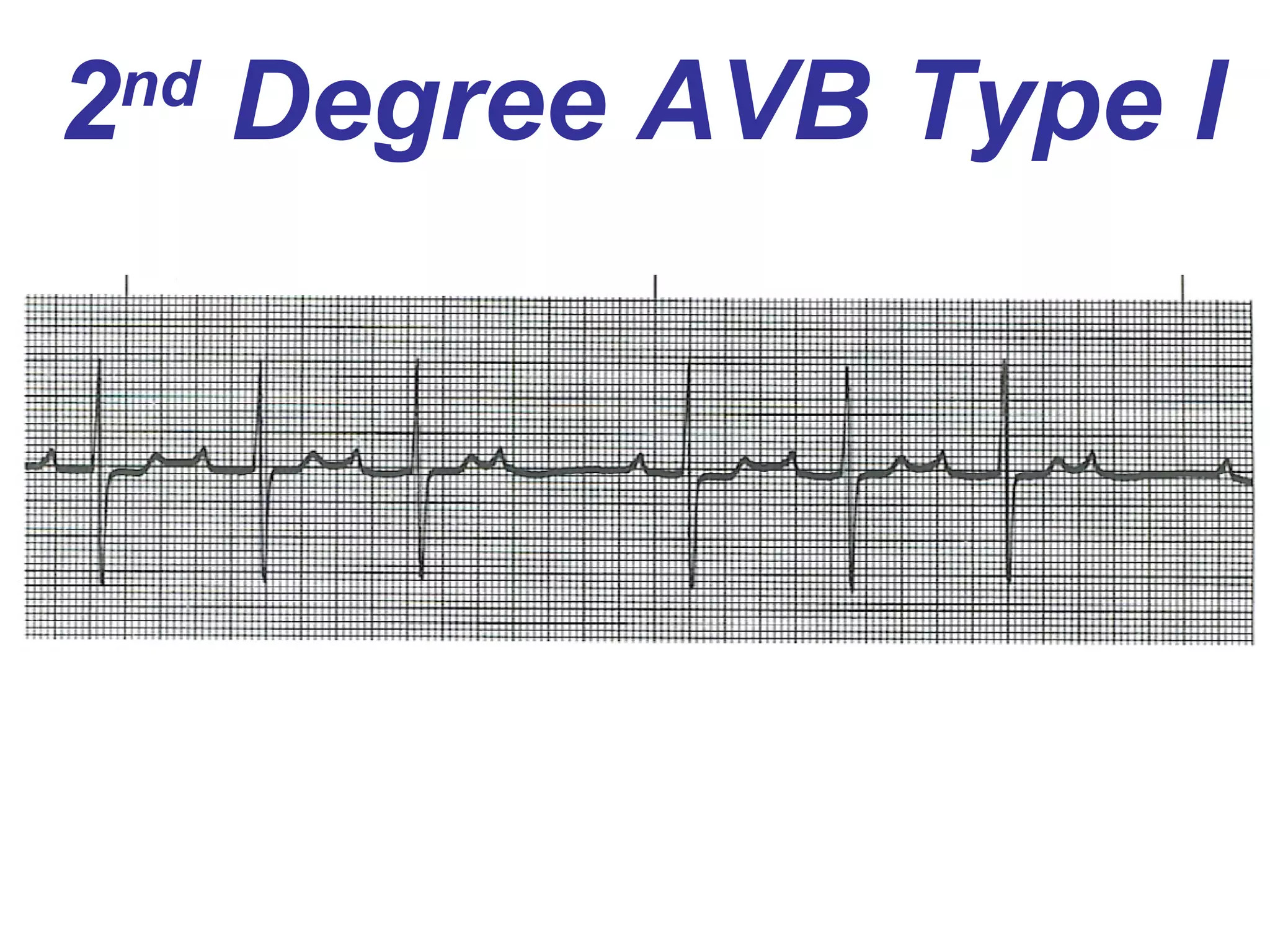 2 nd  Degree AVB Type I 