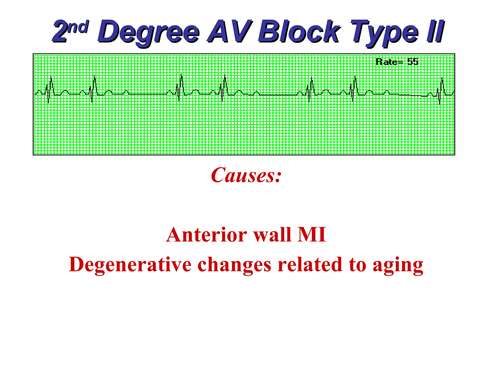 2 nd  Degree AV Block Type II Causes: Anterior wall MI Degenerative changes related to aging 