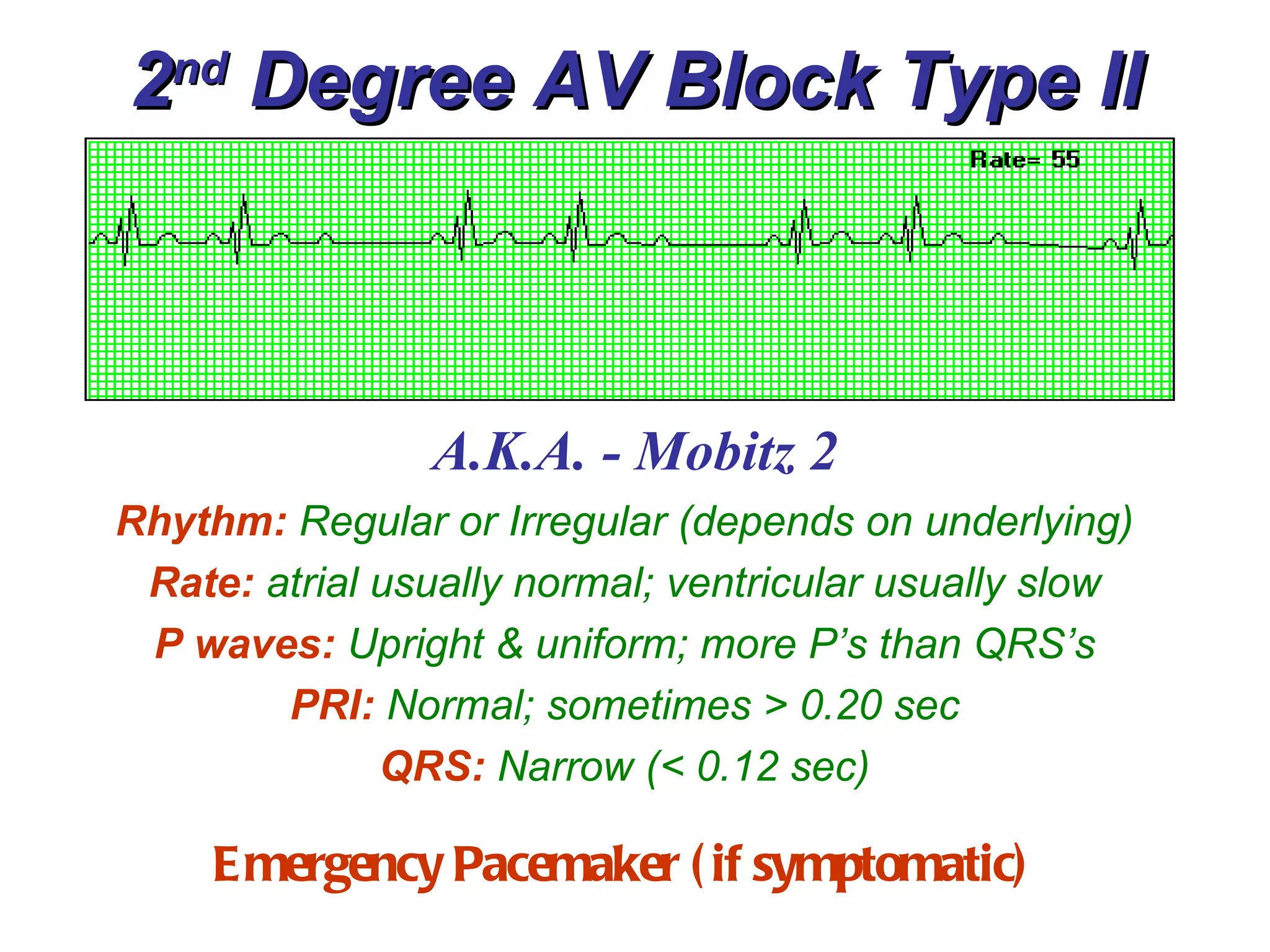 2 nd  Degree AV Block Type II A.K.A. - Mobitz 2 Rhythm:   Regular or Irregular (depends on underlying) Rate:   atrial usually normal; ventricular usually slow P waves:   Upright & uniform; more P’s than QRS’s PRI:   Normal; sometimes > 0.20 sec QRS:   Narrow (< 0.12 sec) Emergency Pacemaker (if symptomatic) 
