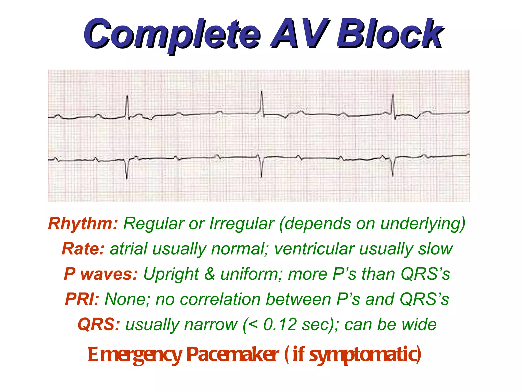 Complete AV Block Emergency Pacemaker (if symptomatic) Rhythm:  Regular or Irregular (depends on underlying) Rate:  atrial usually normal; ventricular usually slow P waves:  Upright & uniform; more P’s than QRS’s PRI:  None; no correlation between P’s and QRS’s QRS:  usually narrow (< 0.12 sec); can be wide 