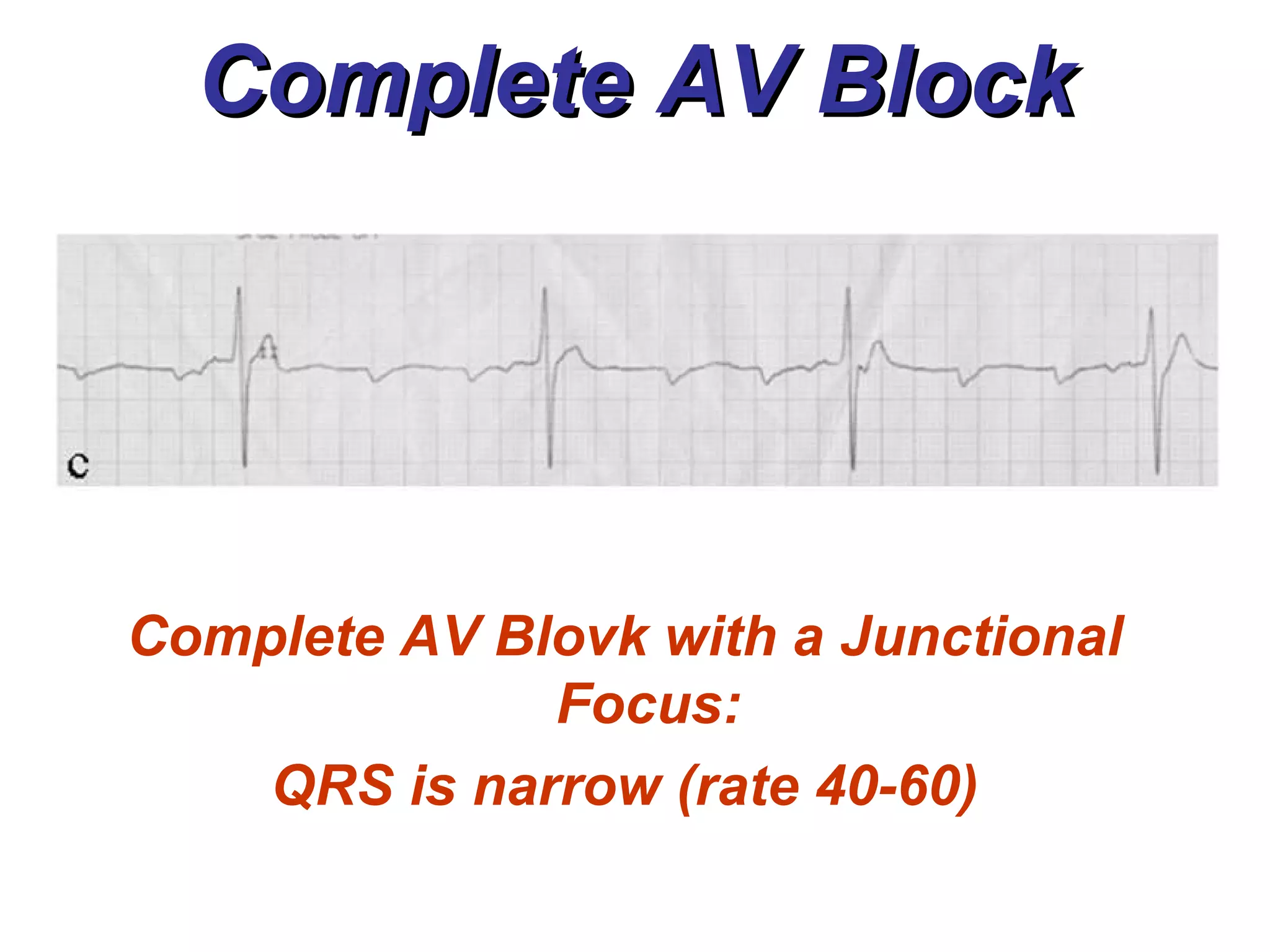 Complete AV Block Complete AV Blovk with a Junctional Focus: QRS is narrow (rate 40-60) 
