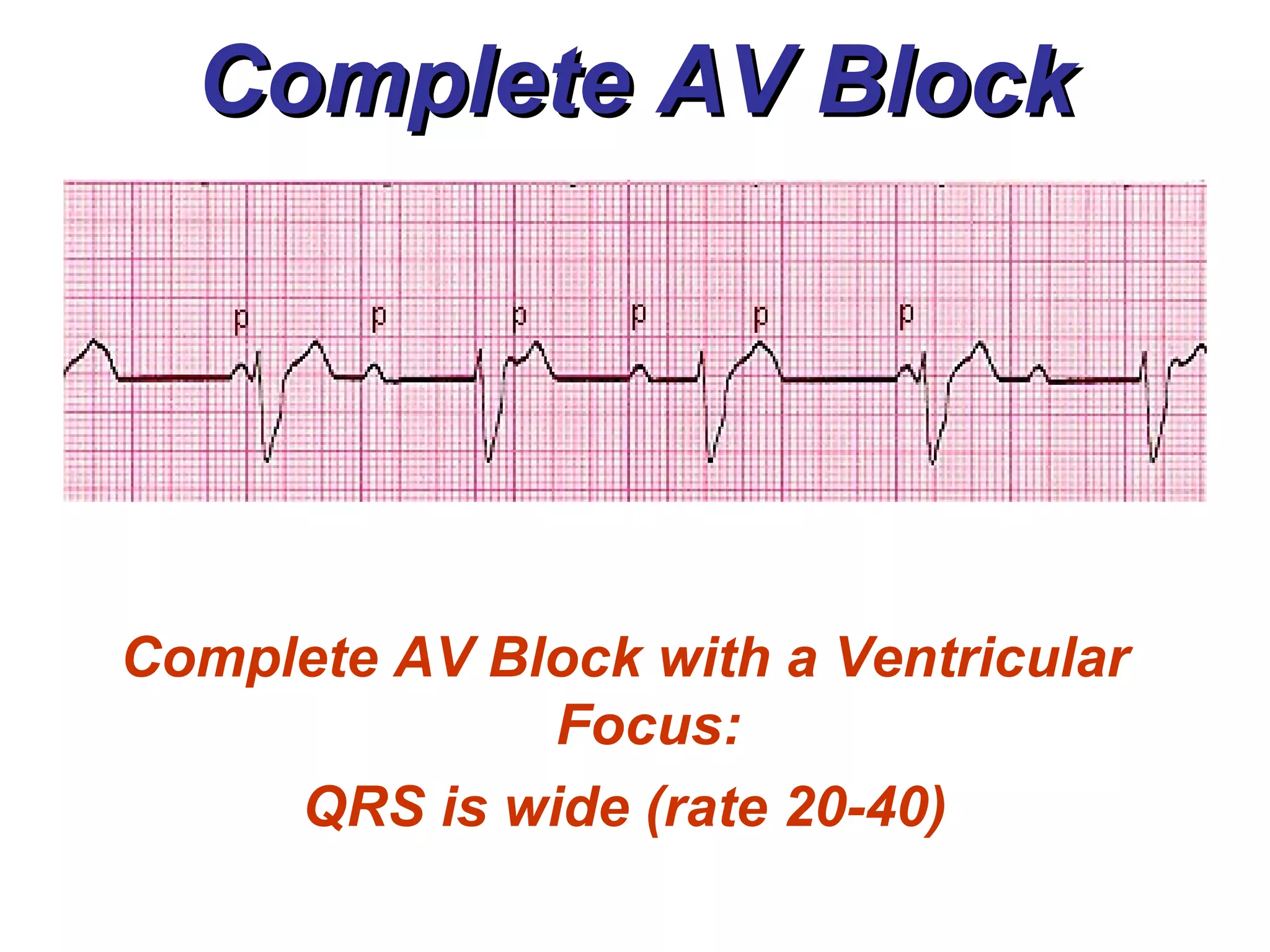 Complete AV Block Complete AV Block with a Ventricular Focus: QRS is wide (rate 20-40) 
