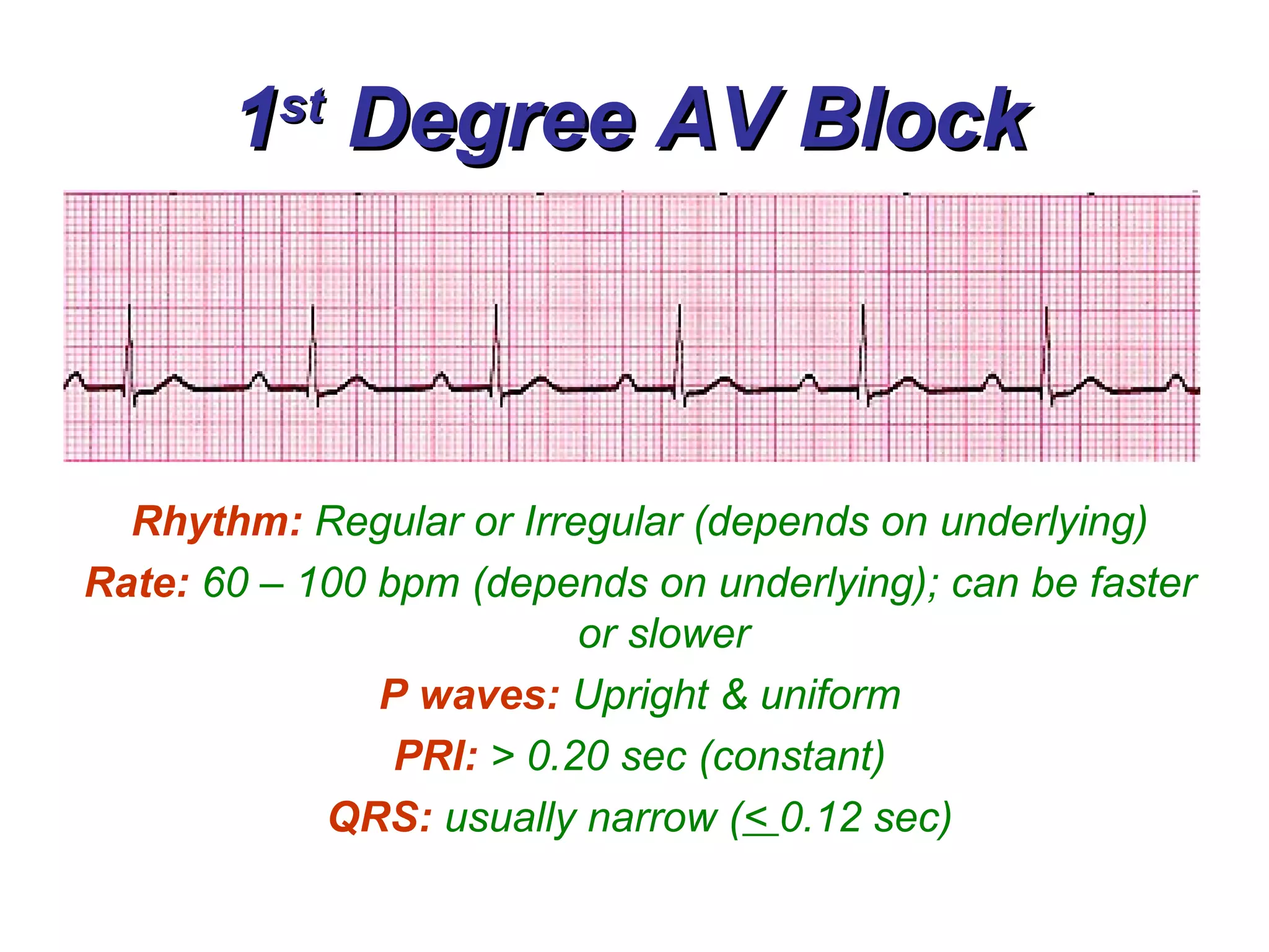 1 st  Degree AV Block Rhythm:   Regular or Irregular (depends on underlying) Rate:   60 – 100 bpm (depends on underlying); can be faster or slower P waves:   Upright & uniform PRI:   > 0.20 sec (constant) QRS:   usually narrow ( <  0.12 sec) 