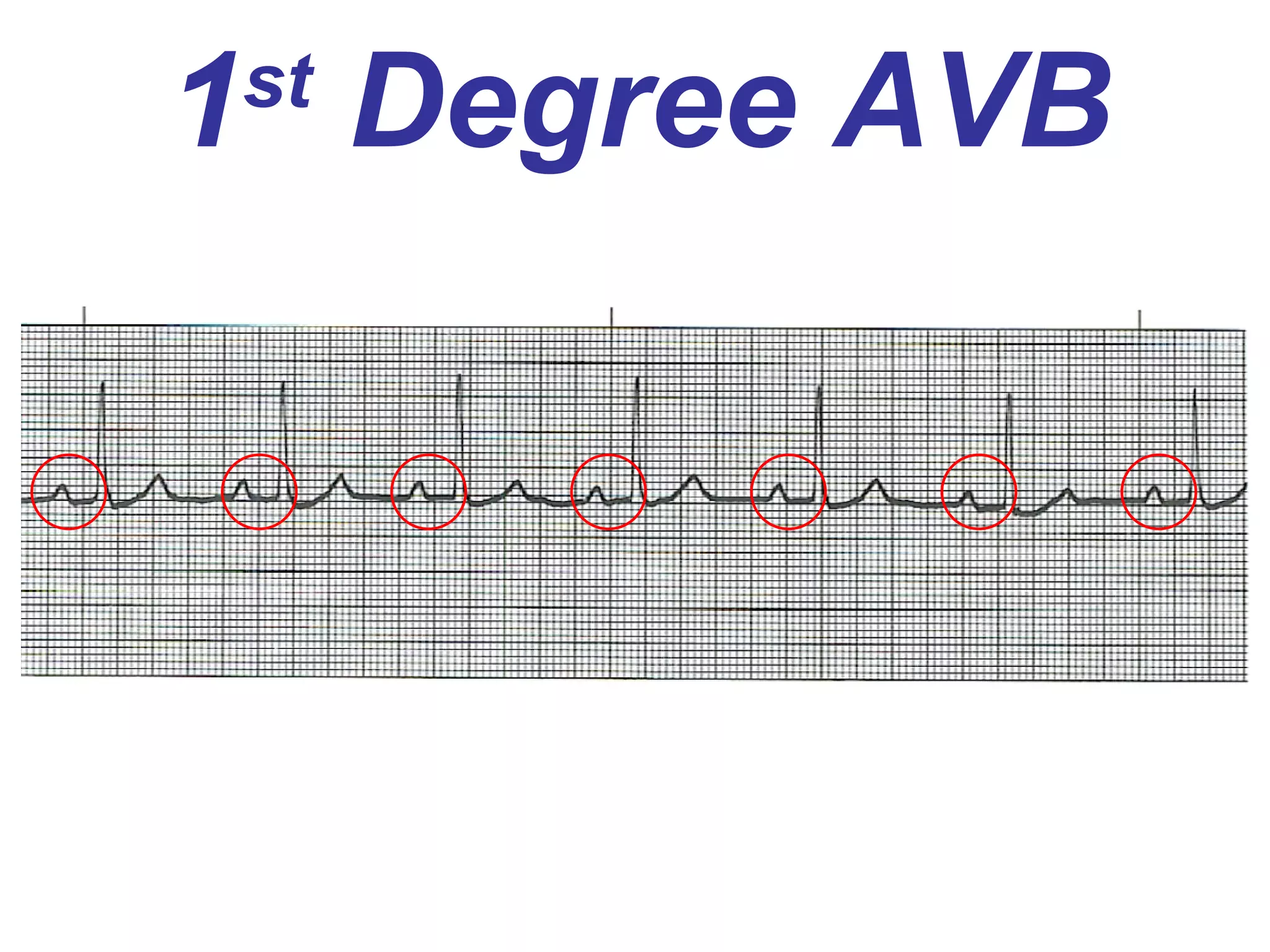 1 st  Degree AVB 