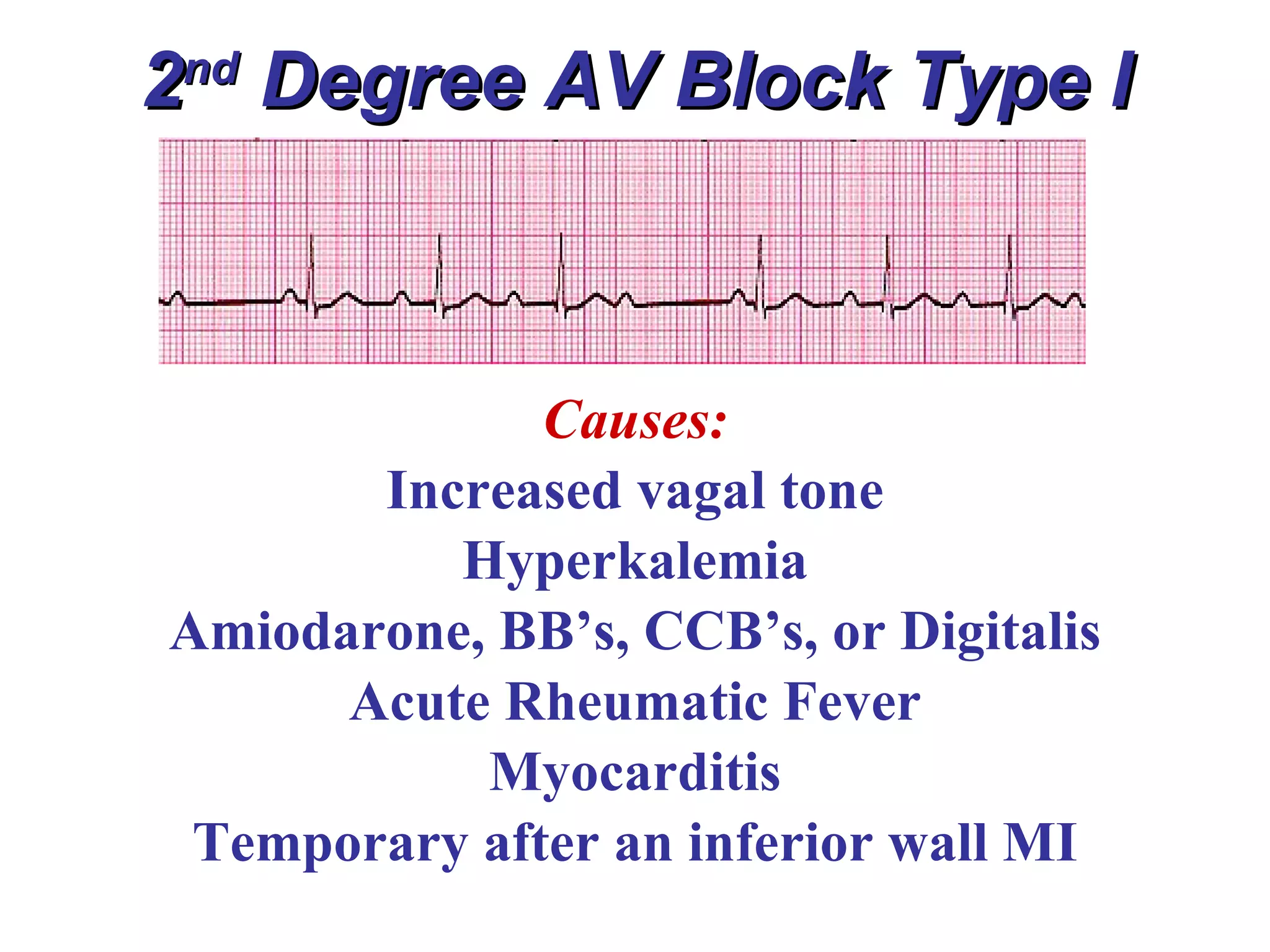 2 nd  Degree AV Block Type I Causes: Increased vagal tone Hyperkalemia Amiodarone, BB’s, CCB’s, or Digitalis Acute Rheumatic Fever Myocarditis Temporary after an inferior wall MI 
