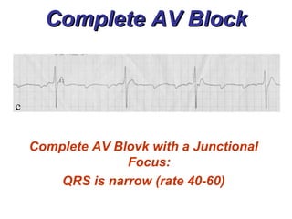 Atrioventricular Blocks - BMH/Tele | PPT