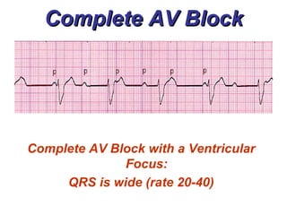 Av Block Visual Atrioventricular Blocks - BMH/Tele | PPT