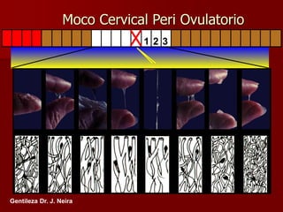 1 2 3
Gentileza Dr. J. Neira
Moco Cervical Peri Ovulatorio
 