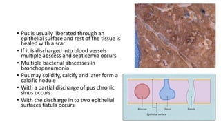 Multiple Abscess Acute Inflammation and inflammation types | PDF