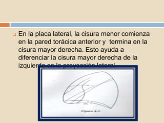  En la placa lateral, la cisura menor comienza
en la pared torácica anterior y termina en la
cisura mayor derecha. Esto ayuda a
diferenciar la cisura mayor derecha de la
izquierda en la proyección lateral.
 