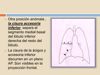  Otra posición anómala ,
la cisura accesoria
inferior, separa el
segmento medial basal
del lóbulo inferior
derecha del resto del
lóbulo.
 La cisura de la ácigos y
accesoria inferior
discurren en un plano
AP. Son visibles en la
proyección frontal.
 